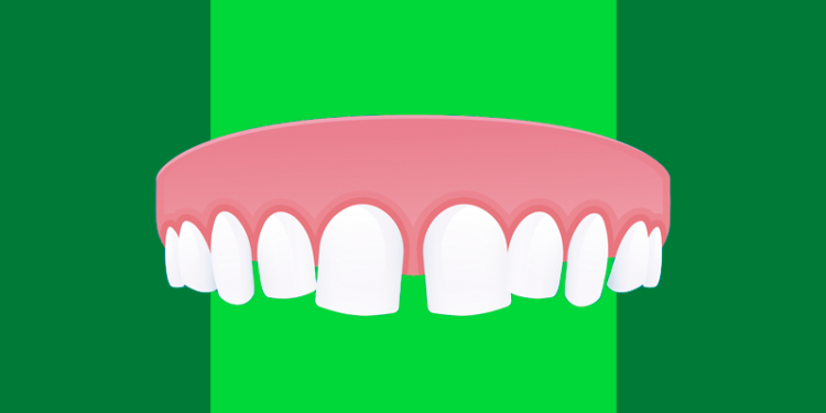 diastema