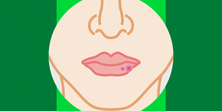 inchaco dos labios