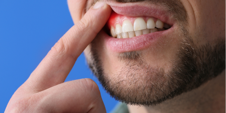 principais remedios caseiros para gengivite