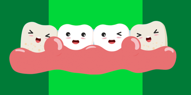 Ilustração de gengiva inchada devido a gengivite