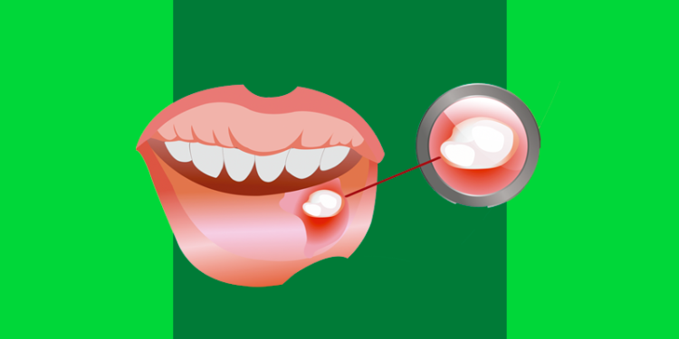 Ilustração de boca com mucocele