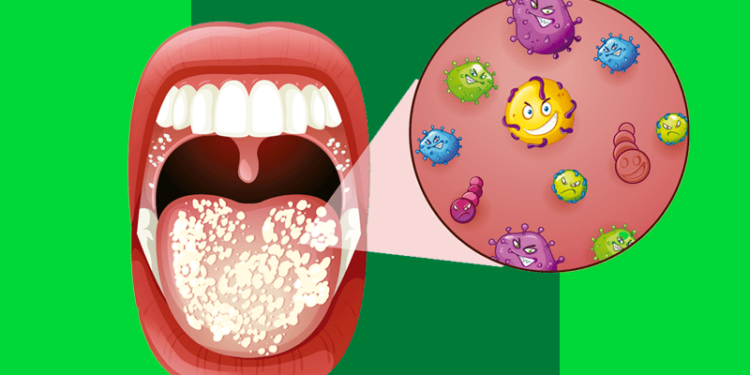 Ilustração mostra boca com foco em sapinho na boca