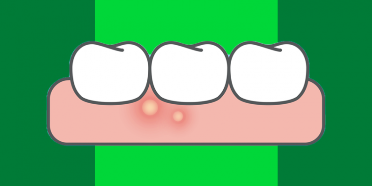 Afta na gengiva: principais causas e tratamentos