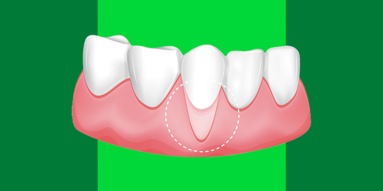 dentinhos com a gengiva retraída em um deles, representando a necessidade de um enxerto de gengiva