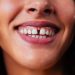 O que é a frenectomia e como a cirurgia é feita?