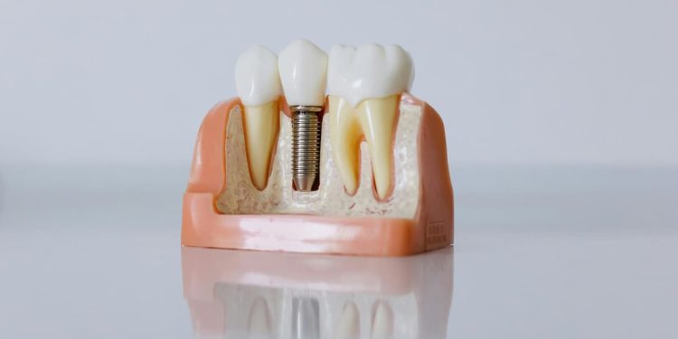 Modelo de prótese dentária.