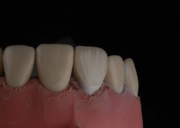 imagem de uma gengiva inflamada